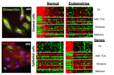 Stromal and epithelial cells, separated from endometrial biopsies, show distinct gene expression profiles in endometriosise 